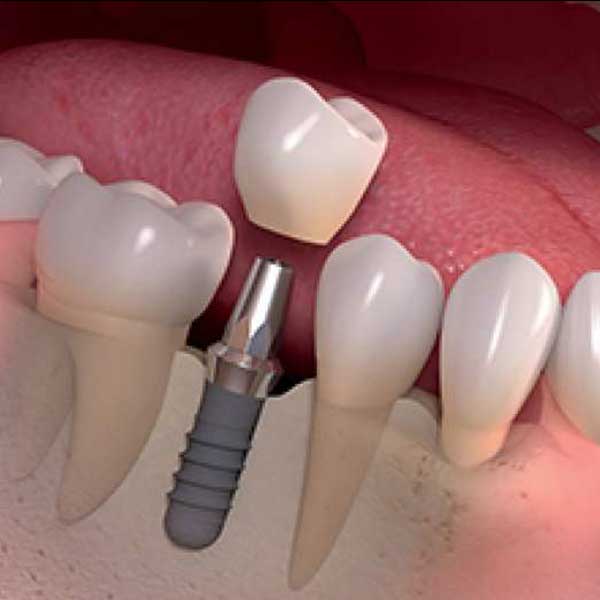 Single tooth implant